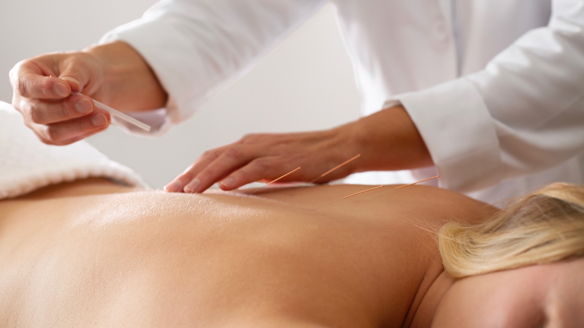 Acupuncture, Strata Integrated Wellness & Spa, Garden of the Gods Resort, Spas of America Acupuncture, Strata Integrated Wellness & Spa, Garden of the Gods Resort, Spas of America