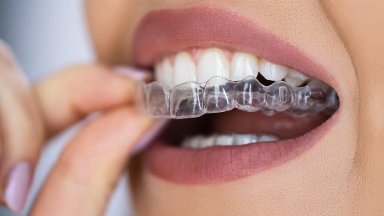 Invisalign vs Braces: Which Is the Better Option for You? Spas of America