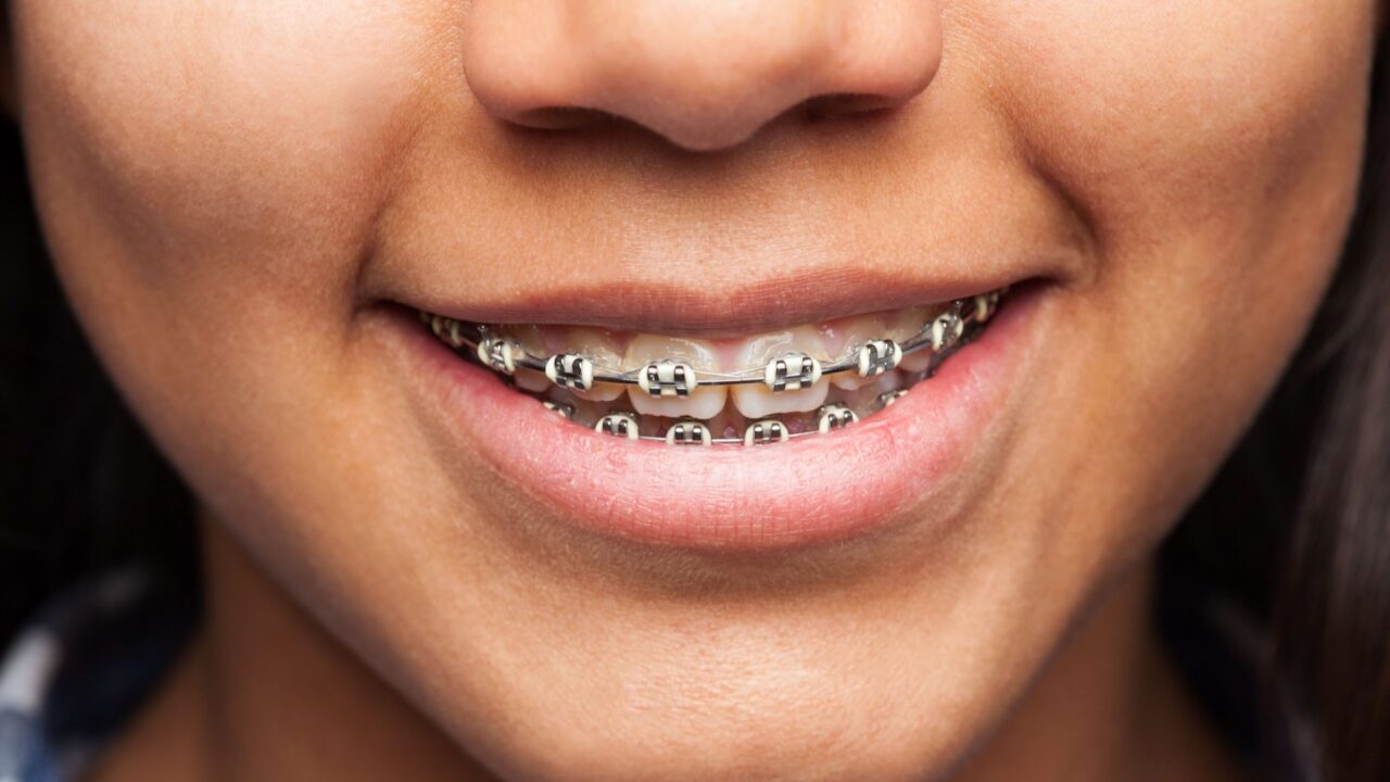 Invisalign vs Braces: Which Is the Better Option for You? Spas of America