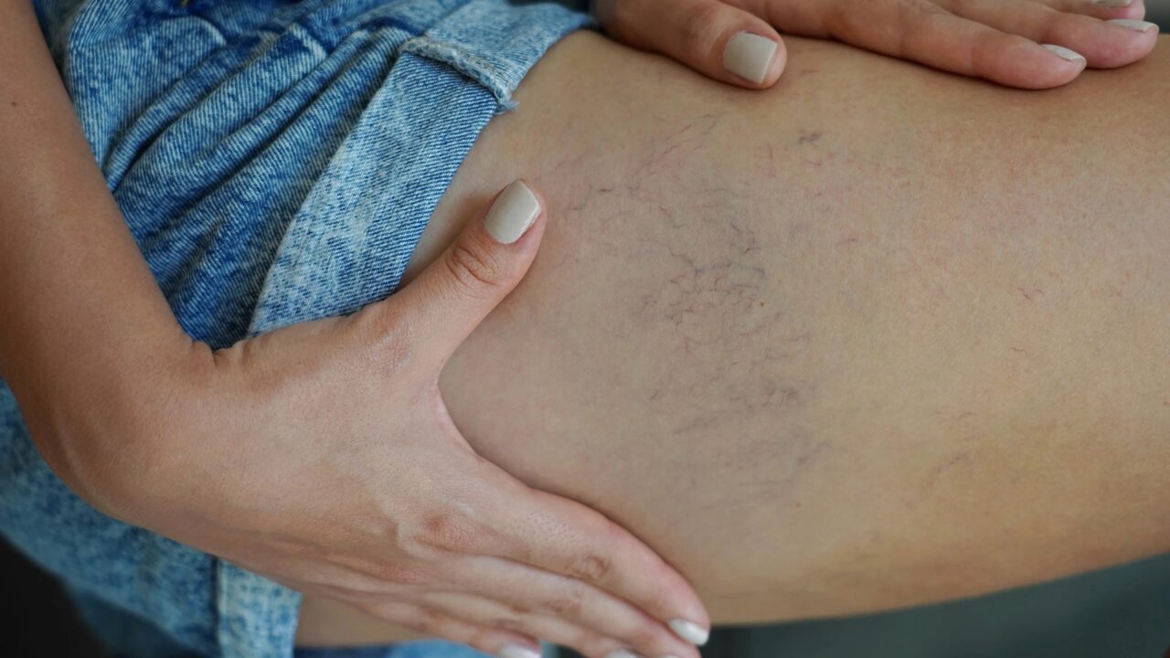 Restore Confidence With Advanced Spider Vein Treatments